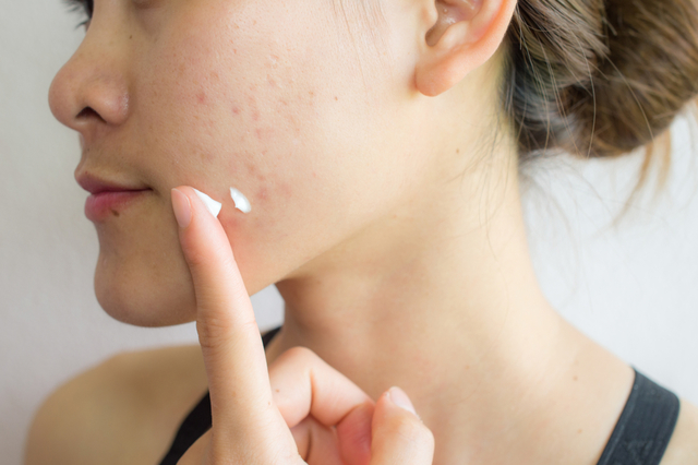 自分でニキビの薬を塗る女性